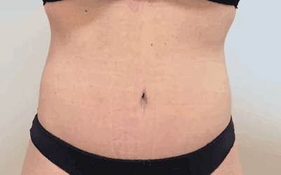 Inicio 15 El abdomen después de perder peso: por qué la dieta y el ejercicio no siempre son suficientes