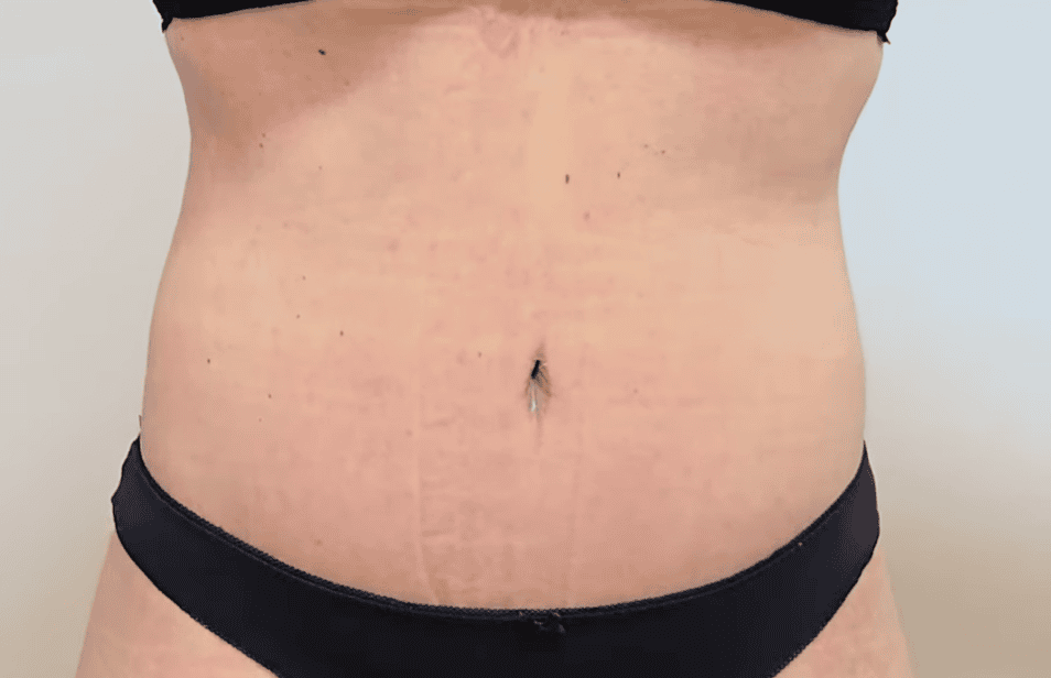 resultado de liposuccion en el abdomen