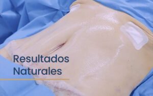 Resultados naturales tra una liposuccion y abdominoplastia