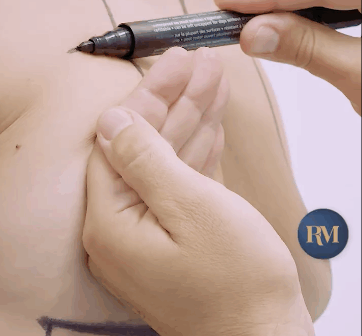 pintando sobre el pecho para obtener la medida ideal en un aumento