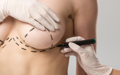 Aumento de pecho en plano retromuscular: resultados firmes, naturales y elegantes